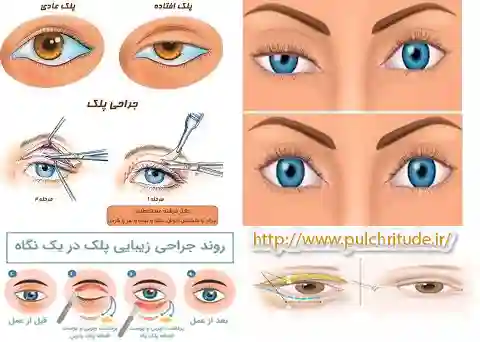 جراحی افتادگی پلک