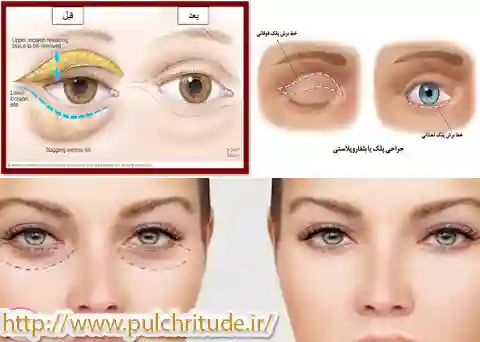 جراحی پلک